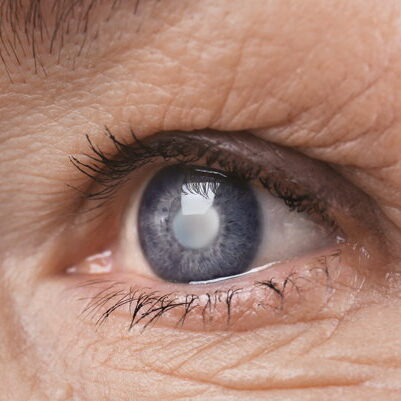 cataracts surgery