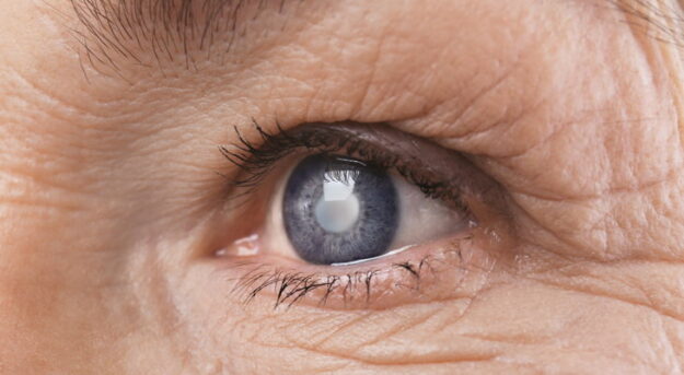 cataracts surgery