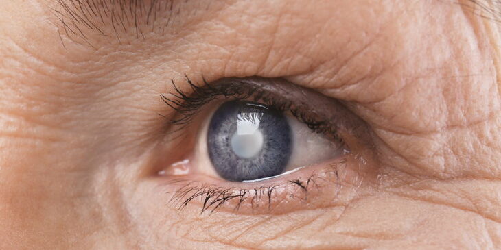 cataracts surgery